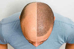 Hair Transplant Before & After Photos Birmingham, AL