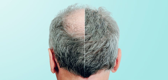 FUE-Hair-Transplant-Alabama