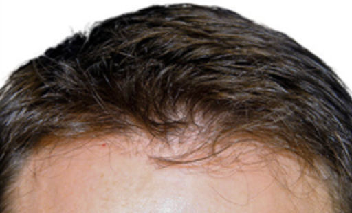 ARTAS Robotic Hair Restoration Before & After Patient #103