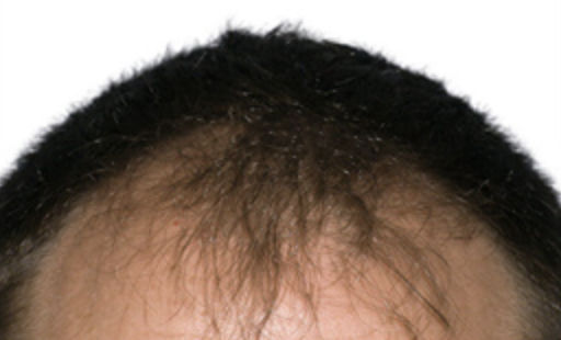 ARTAS Robotic Hair Restoration Before & After Patient #103