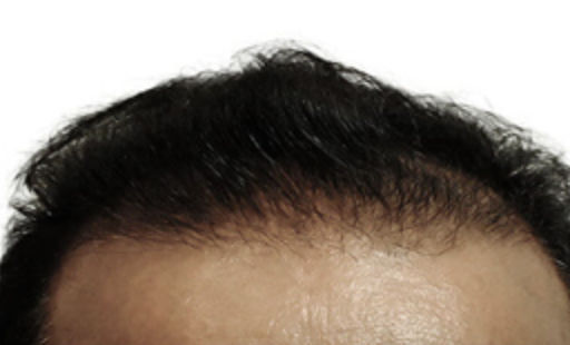 ARTAS Robotic Hair Restoration Before & After Patient #106