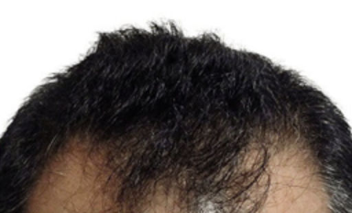 ARTAS Robotic Hair Restoration Before & After Patient #106