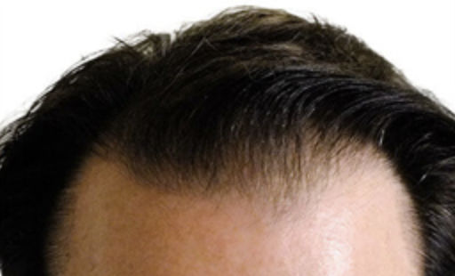 ARTAS Robotic Hair Restoration Before & After Patient #109
