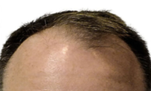 ARTAS Robotic Hair Restoration Before & After Patient #109