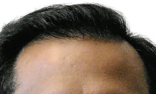 ARTAS Robotic Hair Restoration Before & After Patient #88