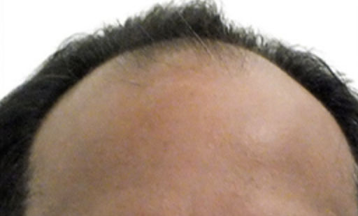 ARTAS Robotic Hair Restoration Before & After Patient #88