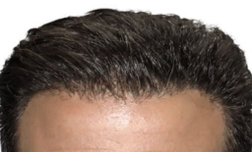 ARTAS Robotic Hair Restoration Before & After Patient #91