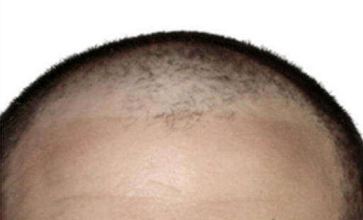 ARTAS Robotic Hair Restoration Before & After Patient #91