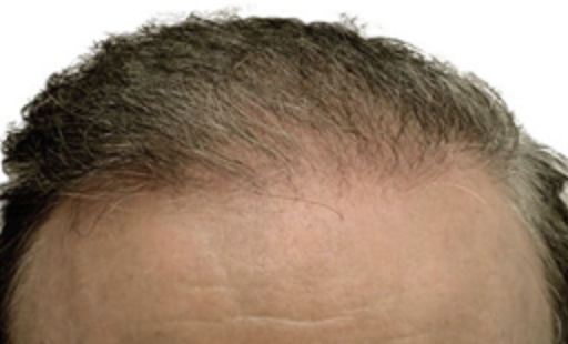 ARTAS Robotic Hair Restoration Before & After Patient #94