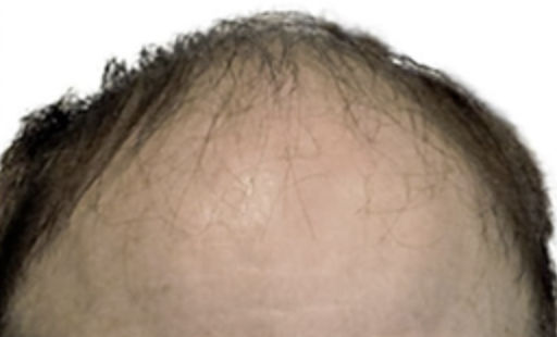 ARTAS Robotic Hair Restoration Before & After Patient #94
