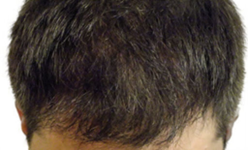 ARTAS Robotic Hair Restoration Before & After Patient #97