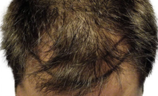 ARTAS Robotic Hair Restoration Before & After Patient #97
