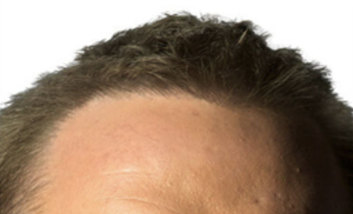 ARTAS Robotic Hair Restoration Before & After Patient #100