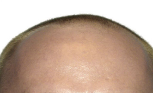 ARTAS Robotic Hair Restoration Before & After Patient #100
