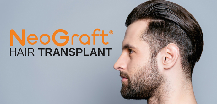 NeoGraft-Hair-Transplant-NeoGraft-Hair-Transplant-Birmingham-Alabama